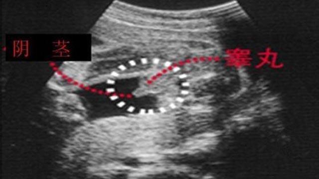 揭秘胎儿性别，关于7个月B超显示的男孩图片的探索